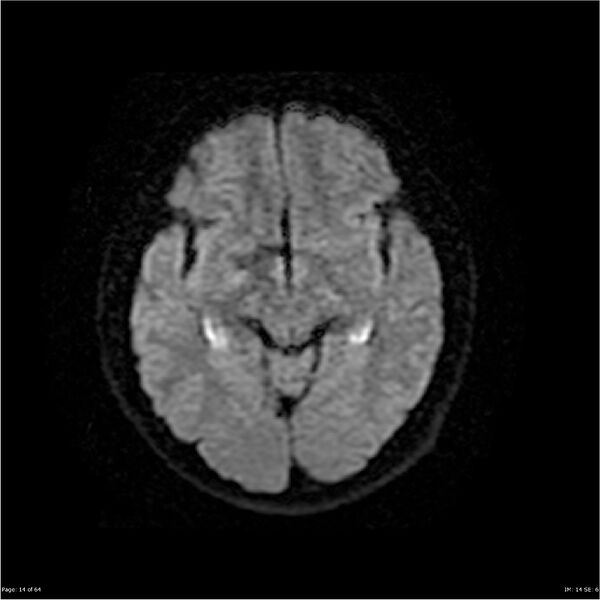 File:Amnestic syndrome secondary to hypoxic brain injury (Radiopaedia 24743-25004 DWI 14).jpg