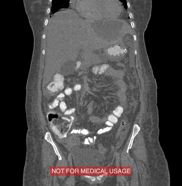 File:Amoebic enterocolitis with liver abscess (Radiopaedia 35100-36609 B 67).jpg