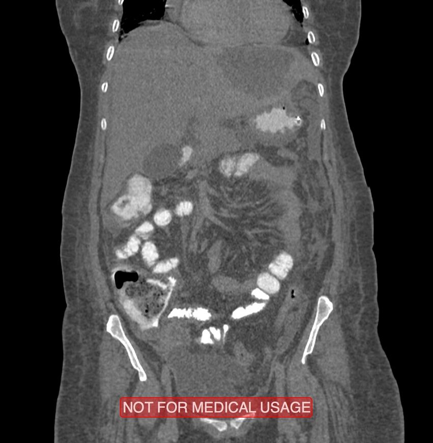 Amoebic enterocolitis with liver abscess (Radiopaedia 35100-36609 B 67).jpg