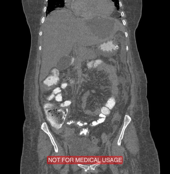 File:Amoebic enterocolitis with liver abscess (Radiopaedia 35100-36609 B 71).jpg