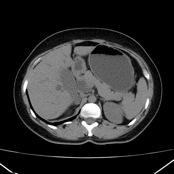 File:Ampullary tumor (Radiopaedia 22787-22816 Axial non-contrast 17).jpg