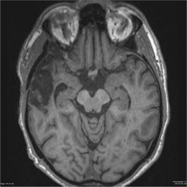 File:Anaplastic meningioma with recurrence (Radiopaedia 34452-35788 Axial T1 52).jpg