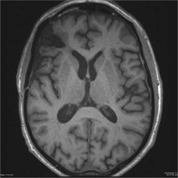 File:Anaplastic meningioma with recurrence (Radiopaedia 34452-35788 Axial T1 73).jpg