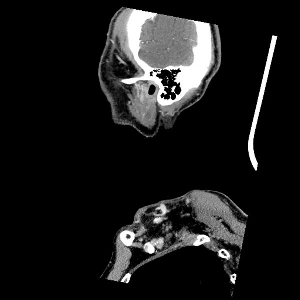 File:Anaplastic thyroid carcinoma (Radiopaedia 79087-92034 C 14).jpg