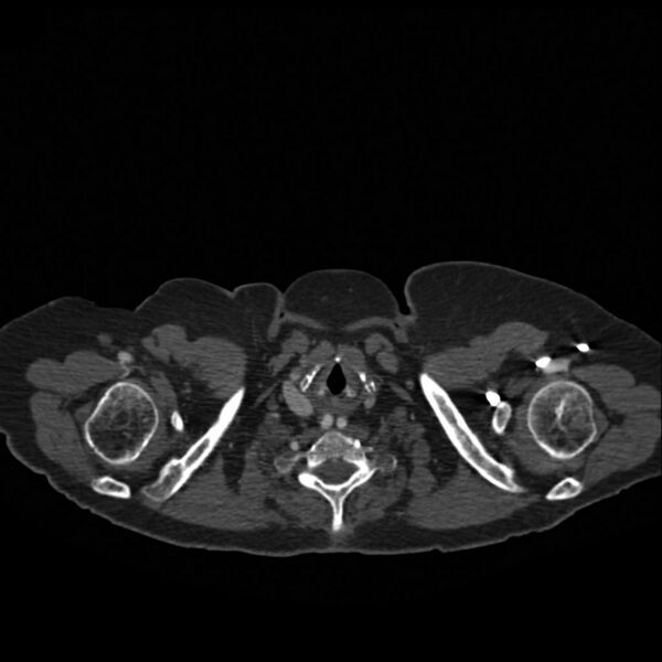 File:Aneurysmal double aortic arch (Radiopaedia 10162).jpg