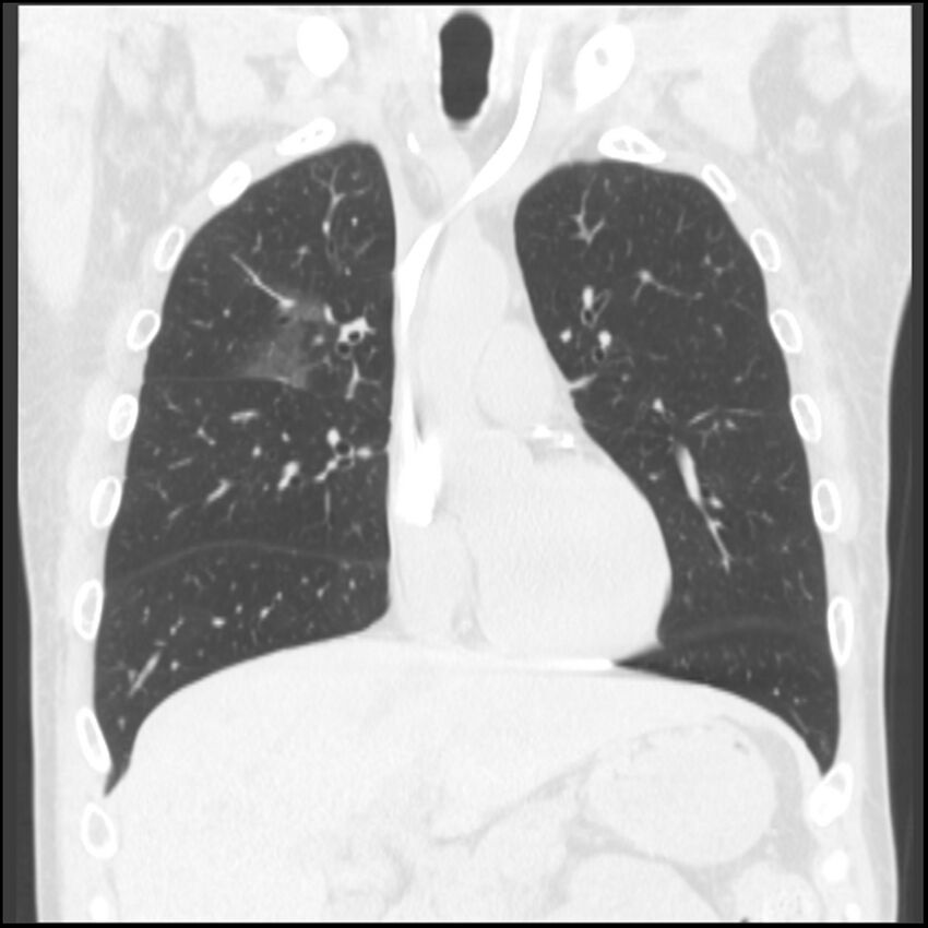 Angioinvasive aspergillosis (Radiopaedia 43957-47466 Coronal lung window 59).jpg