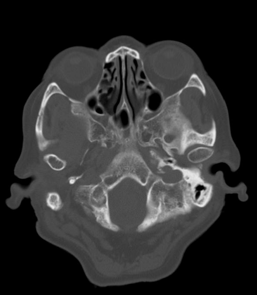 File:Anomalous intracranial venous drainage (Radiopaedia 28161-28418 Axial 15).png