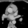 Anomalous right coronary artery (ARCA) with interarterial course (Radiopaedia 12423-12677 B 4).jpg