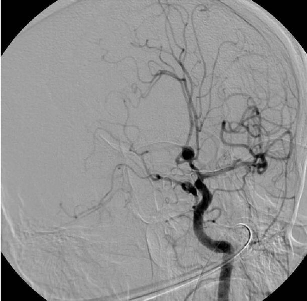 File:Anterior communicating artery aneurysm (Radiopaedia 30938-31638 B 1).JPG