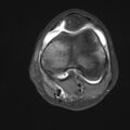Anterior cruciate ligament tear - pediatric (Radiopaedia 62152-70260 Axial PD fat sat 15).jpg