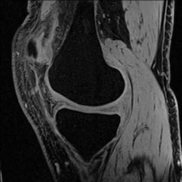 File:Anterior cruciate ligament tear - ramp lesion (Radiopaedia 71883-82322 Sagittal T1 vibe 94).jpg