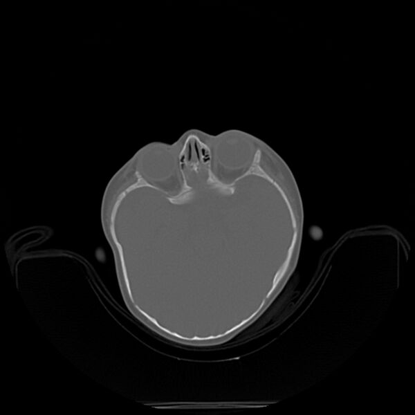 File:Anterior plagiocephaly (Radiopaedia 71836-82273 C 11).jpg