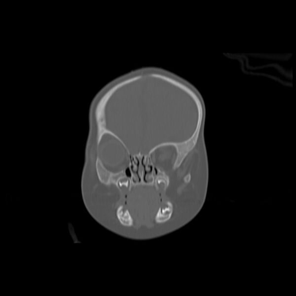 File:Anterior plagiocephaly (Radiopaedia 71836-82273 Coronal bone window 12).jpg