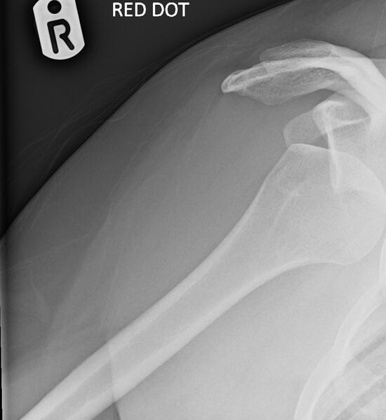 File:Anterior shoulder dislocation (Radiopaedia 63139-71656 Axial 1).jpg