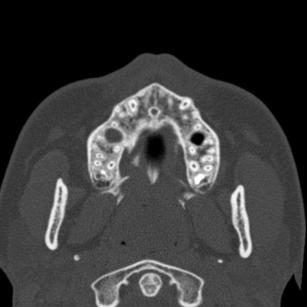 File:Antrochoanal polyp (Radiopaedia 21894-21868 Axial bone window 8).jpg