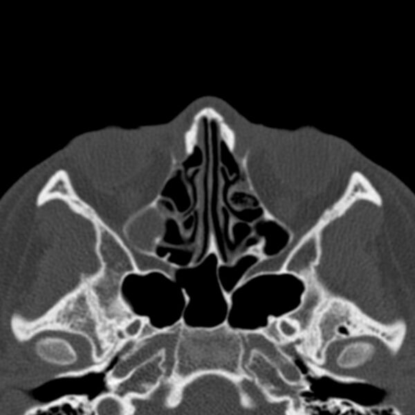 File:Antrochoanal polyp (Radiopaedia 33984-35202 Axial bone window 42).jpg
