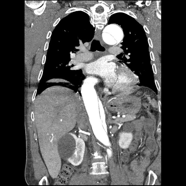 File:Aortic dissection - DeBakey Type I-Stanford A (Radiopaedia 79863-93115 B 21).jpg