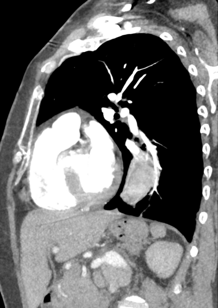 File:Aortic dissection - Stanford type B (Radiopaedia 50171-55512 C 18).png