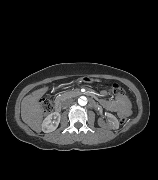 File:Aortic dissection with renal ischemia (Radiopaedia 76573-88338 A 71).jpg