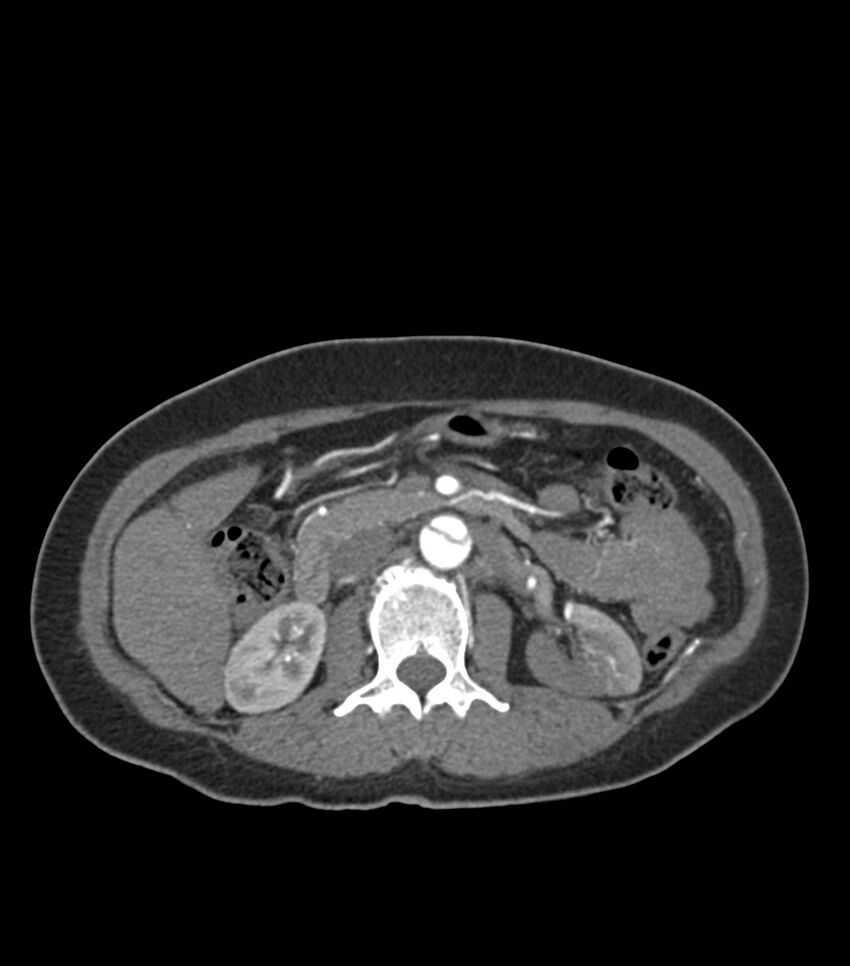 Aortic dissection with renal ischemia (Radiopaedia 76573-88338 A 71).jpg