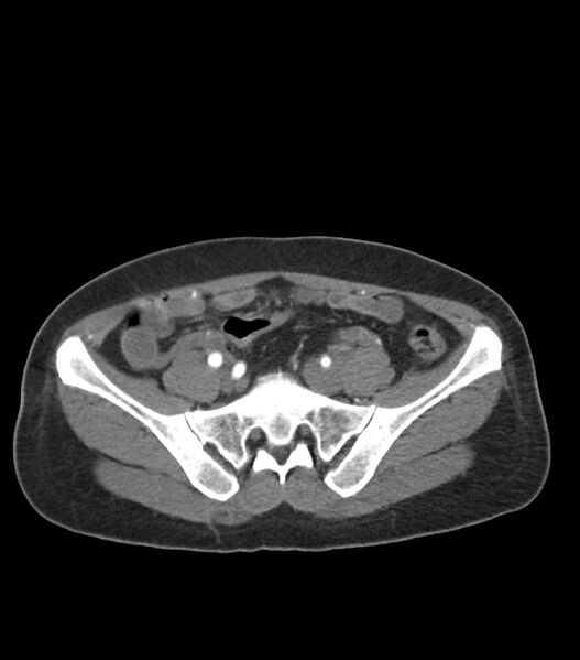 File:Aortic dissection with renal ischemia (Radiopaedia 76573-88338 A 93).jpg