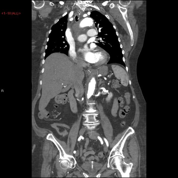 File:Aortic intramural hematoma (Radiopaedia 27746-28001 B 27).jpg