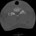 Apical pneumothorax on cervical spine CT (Radiopaedia 45343-49368 Axial bone window 72).jpg