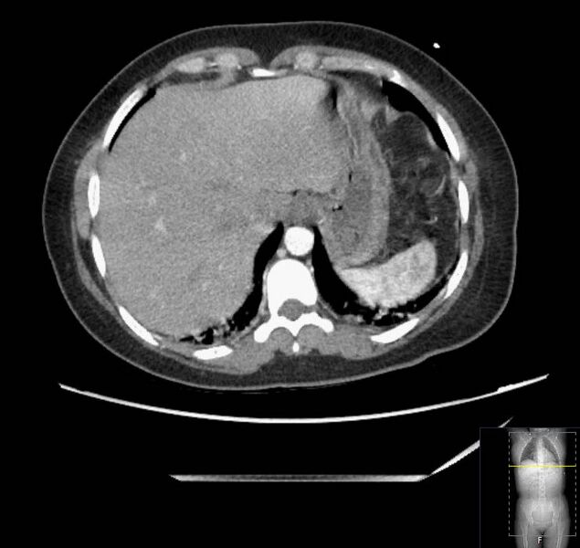 File:Appendicitis (CT angiogram) (Radiopaedia 154713-127660 Axial 168).jpg