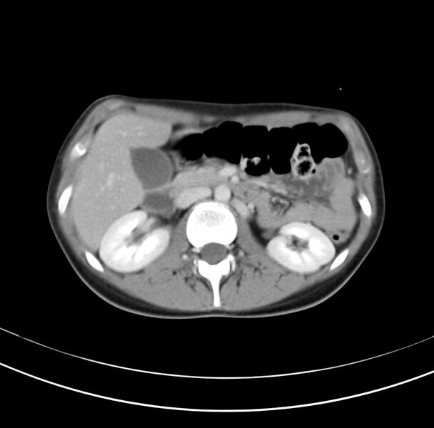 File:Appendicitis and incidental bicornuate uterus (Radiopaedia 22833-22853 B 16).jpg
