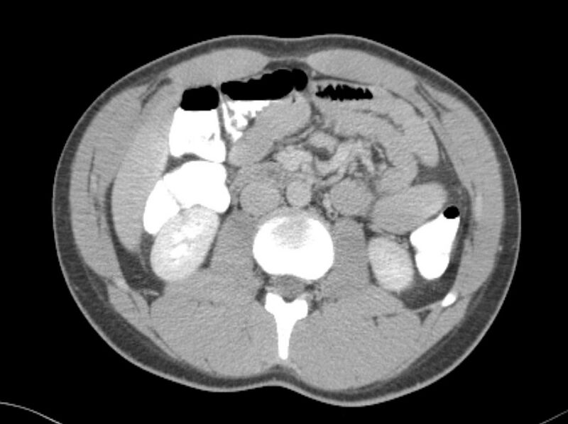 File:Appendicitis and incidental foregut duplication cyst (Radiopaedia 52962-58916 A 26).jpg
