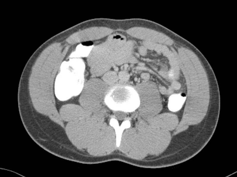 File:Appendicitis and incidental foregut duplication cyst (Radiopaedia 52962-58916 A 38).jpg