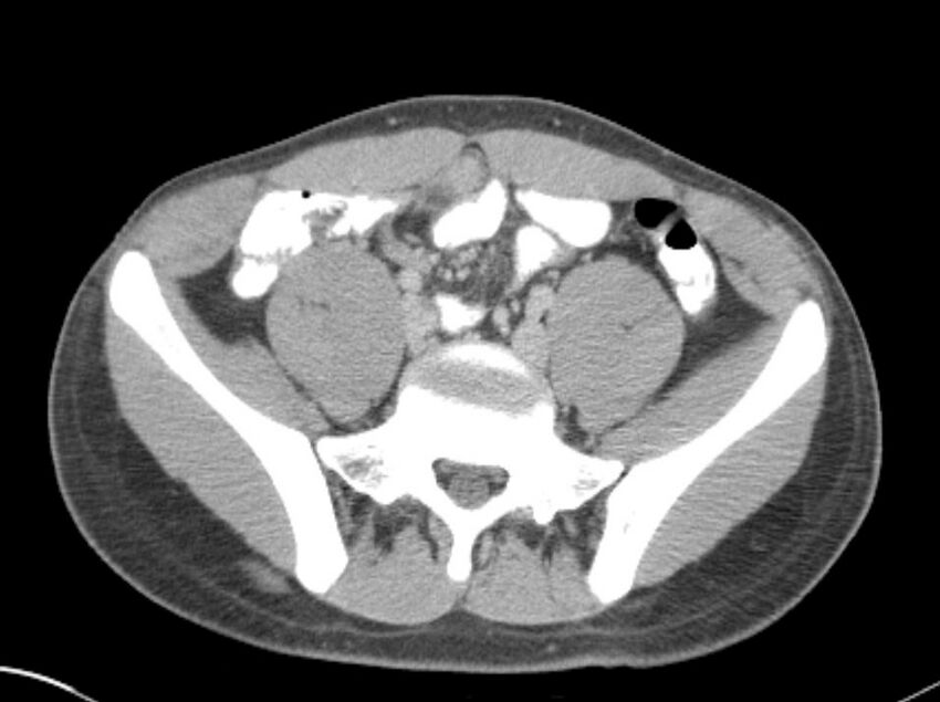 Appendicitis and incidental foregut duplication cyst (Radiopaedia 52962-58916 A 64).jpg