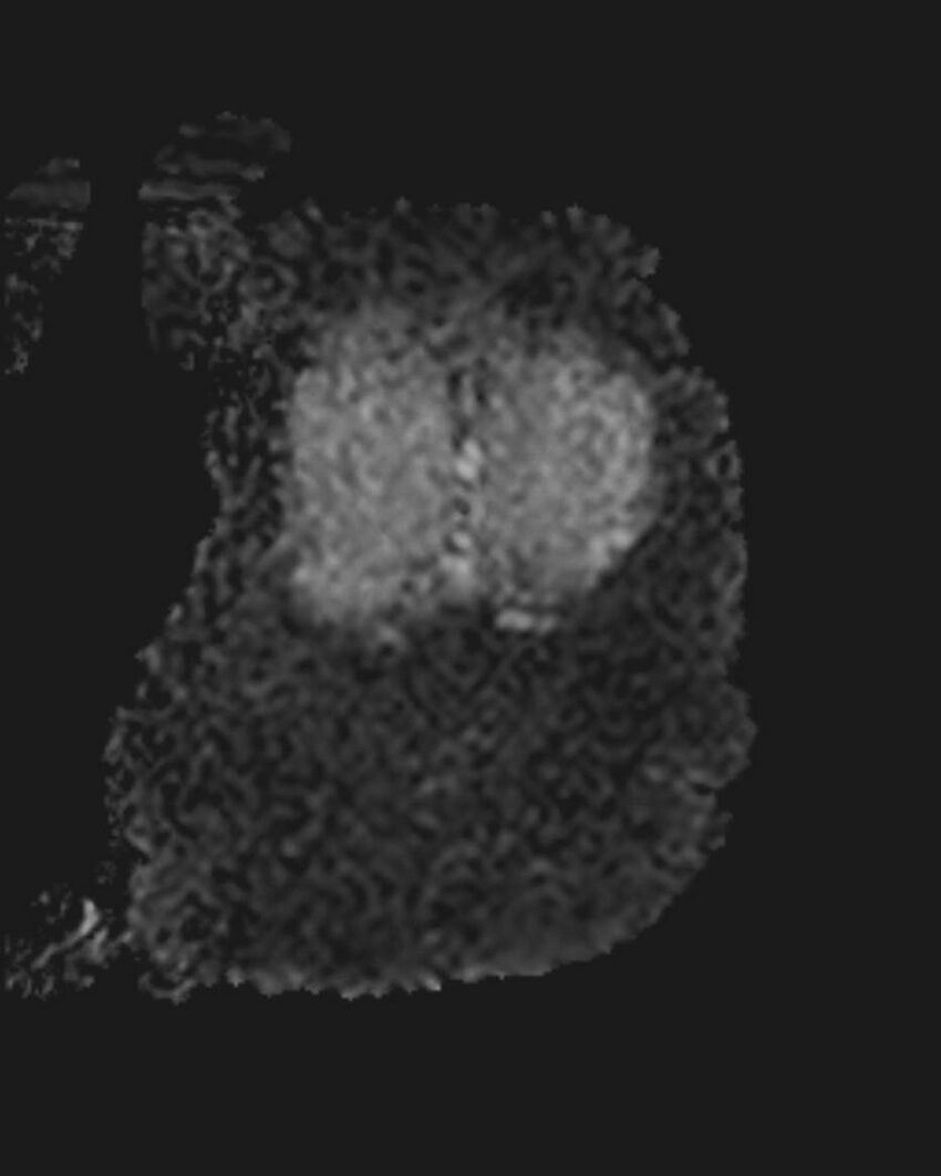 Appendicitis in gravida (MRI) (Radiopaedia 89433-106395 Coronal ADC 54).jpg