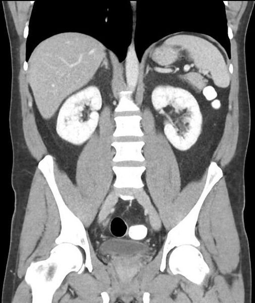 File:Appendicitis with cecal bar sign (Radiopaedia 31878-32830 A 38).jpg