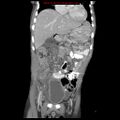 Appendicitis with phlegmon (Radiopaedia 9358-10046 B 22).jpg
