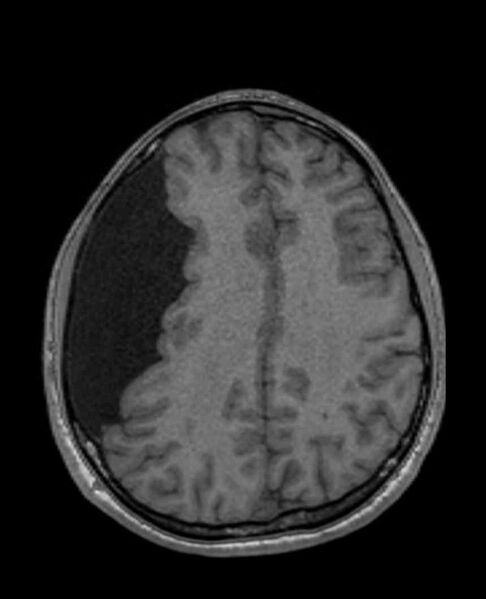 File:Arachnoid cyst- extremely large (Radiopaedia 68741-78451 Axial T1 52).jpg