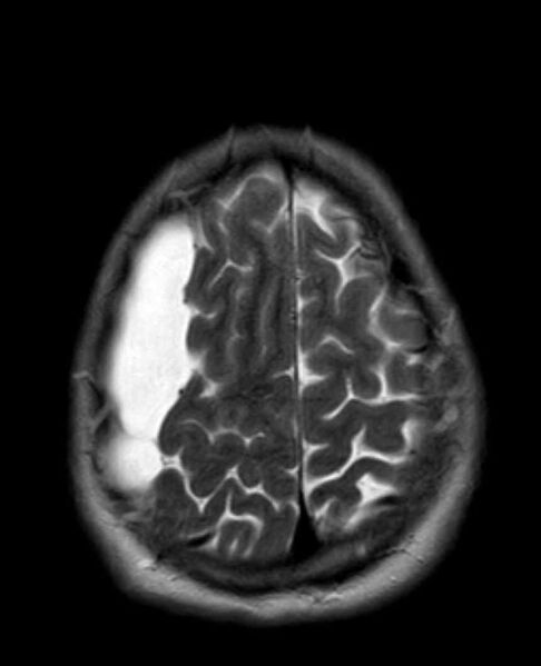File:Arachnoid cyst- extremely large (Radiopaedia 68741-78451 Axial T2 23).jpg