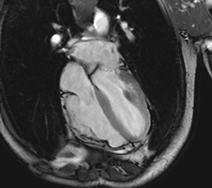 File:Arrhythmogenic right ventricular cardiomyopathy (Radiopaedia 39806-42237 D 41).jpg