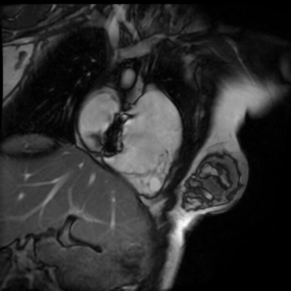 File:Arrhythmogenic right ventricular cardiomyopathy (Radiopaedia 87505-103850 2ch (RV) Cine SSFP 86).jpg