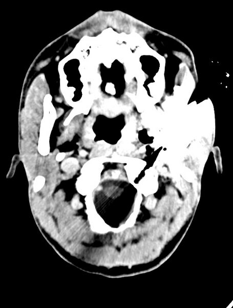 File:Arrow injury to the face (Radiopaedia 73267-84011 Axial C+ delayed 30).jpg