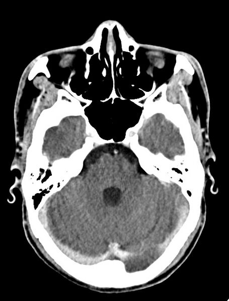 File:Arrow injury to the face (Radiopaedia 73267-84011 Axial C+ delayed 42).jpg