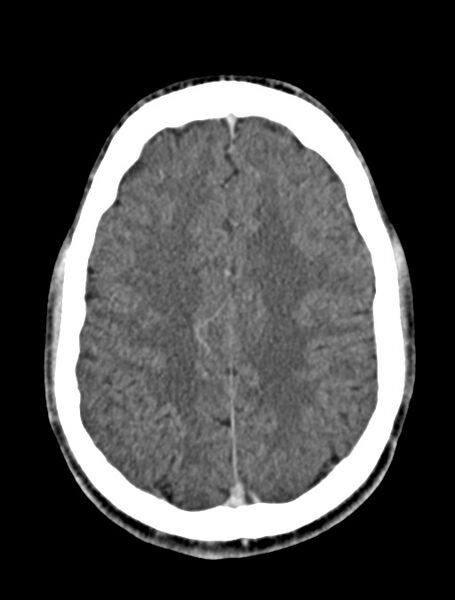 File:Arrow injury to the face (Radiopaedia 73267-84011 Axial C+ delayed 66).jpg