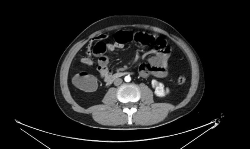 File:Arterial occlusive mesenteric ischemia (Radiopaedia 84641-100060 A 67).jpg