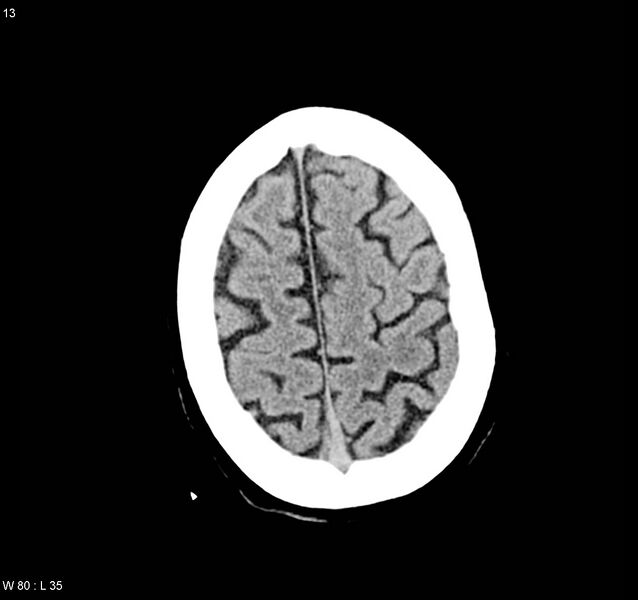 File:Arteriovenous malformation - cerebral (Radiopaedia 8172-9020 Axial non-contrast 21).jpg