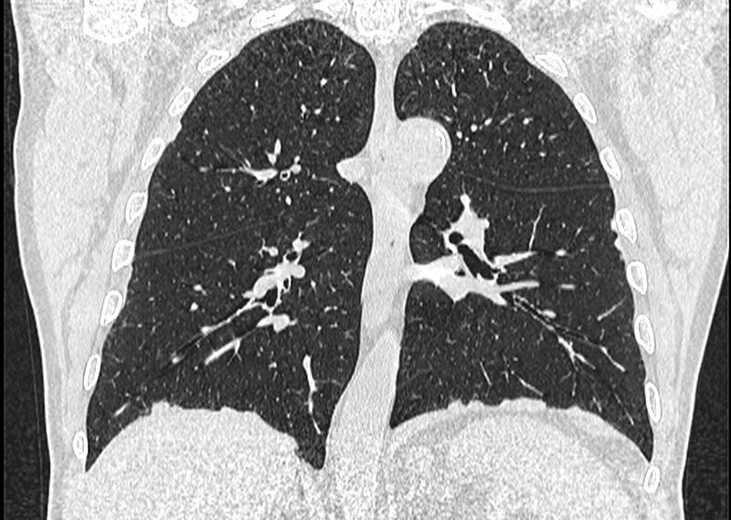 File:Asbestos pleural placques (Radiopaedia 57905-64872 Coronal lung window 176).jpg