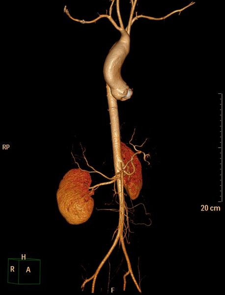 File:Ascending aortic pseudoaneurysm (Radiopaedia 28638-28910 D 2).jpg