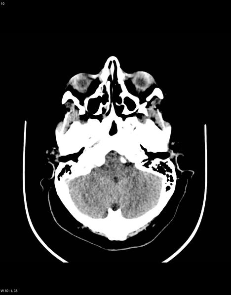 File:Astroblastoma (Radiopaedia 39792-42216 Axial non-contrast 9).jpg
