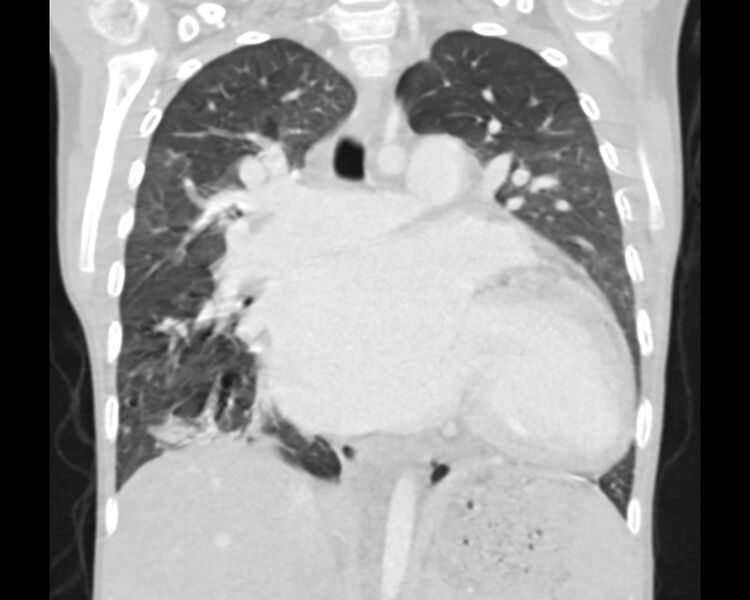 File:Atrial septal defect complicated by Eisenmenger syndrome (Radiopaedia 53707-59768 Sagittal lung window 14).jpg