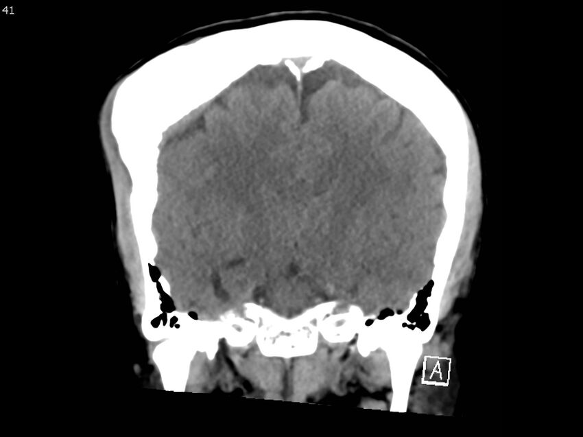 Atypical meningioma - intraosseous (Radiopaedia 64915-73867 B 40).jpg