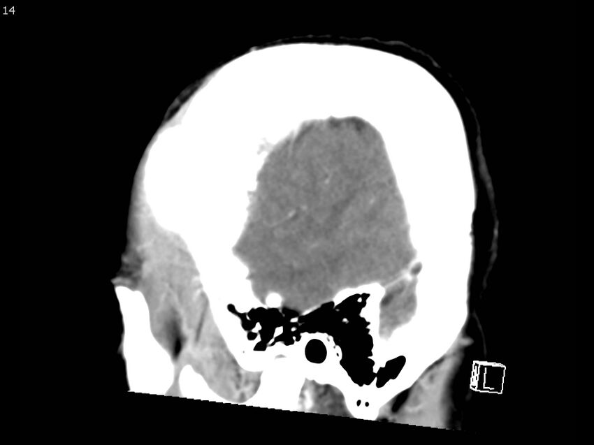 Atypical meningioma - intraosseous (Radiopaedia 64915-73867 F 13).jpg